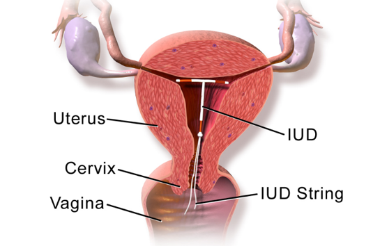 Can I Get An Iud And Breastfeed Infantrisk Center