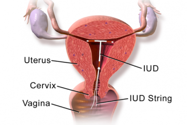 IUD Diagram